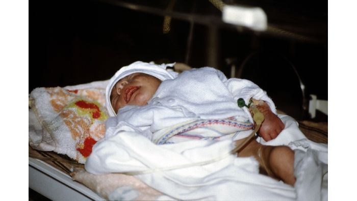 Ein unterernährter Säugling mit Erkrankung der Atemwege im Al-Qadisia-Krankenhaus, Bagdad, der die kommenden Tage nicht überlebt haben dürfte.